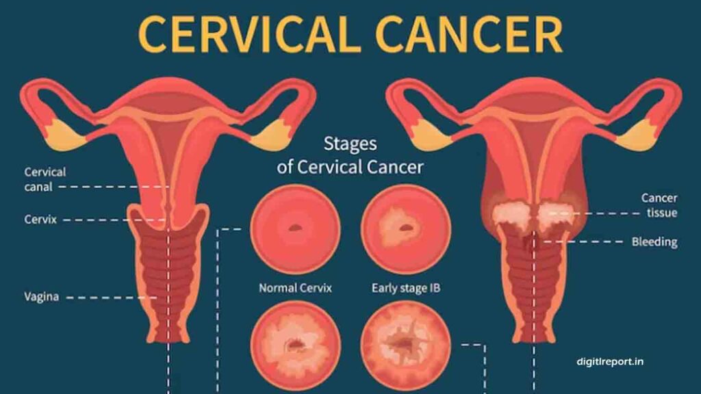 Cervical Cancer