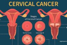 Cervical Cancer