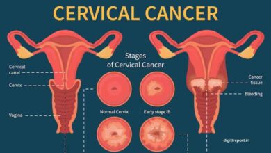 Cervical Cancer