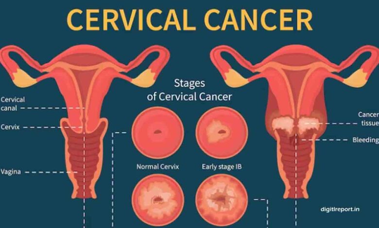 Cervical Cancer